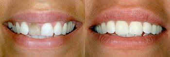 Smile Gallery - Millenia Dental, Chula Vista Dentist