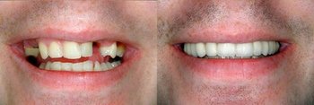 Smile Gallery - Millenia Dental, Chula Vista Dentist