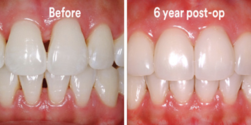 BioClear Diastema Closure and Black Triangle Closure  - Millenia Dental, Chula Vista Dentist