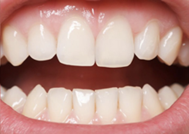 Cosmetic Bonding  - Millenia Dental, Chula Vista Dentist