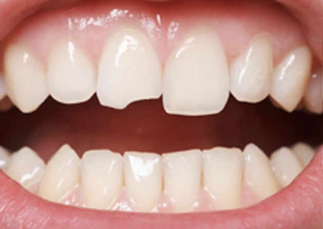 Cosmetic Bonding  - Millenia Dental, Chula Vista Dentist