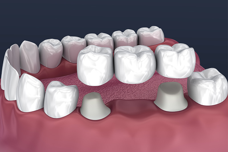 Crowns and Bridges, Inlays and Onlays  - Millenia Dental, Chula Vista Dentist