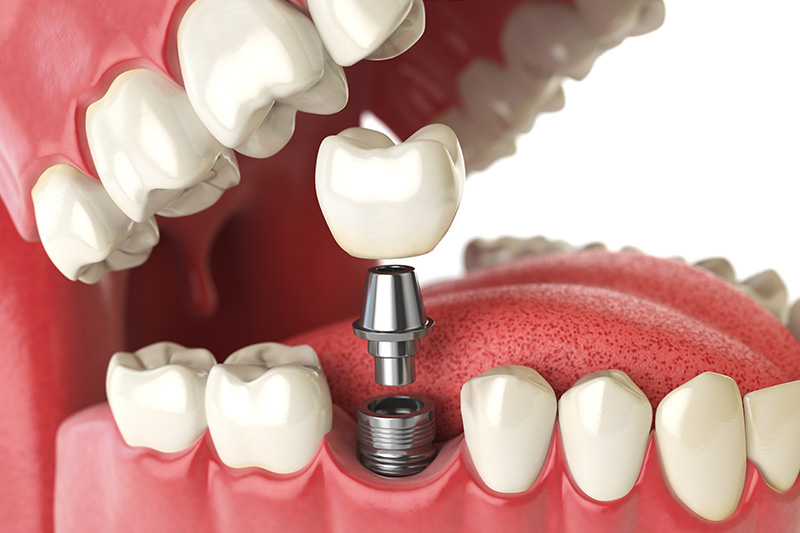 Dental Implants - Millenia Dental, Chula Vista Dentist