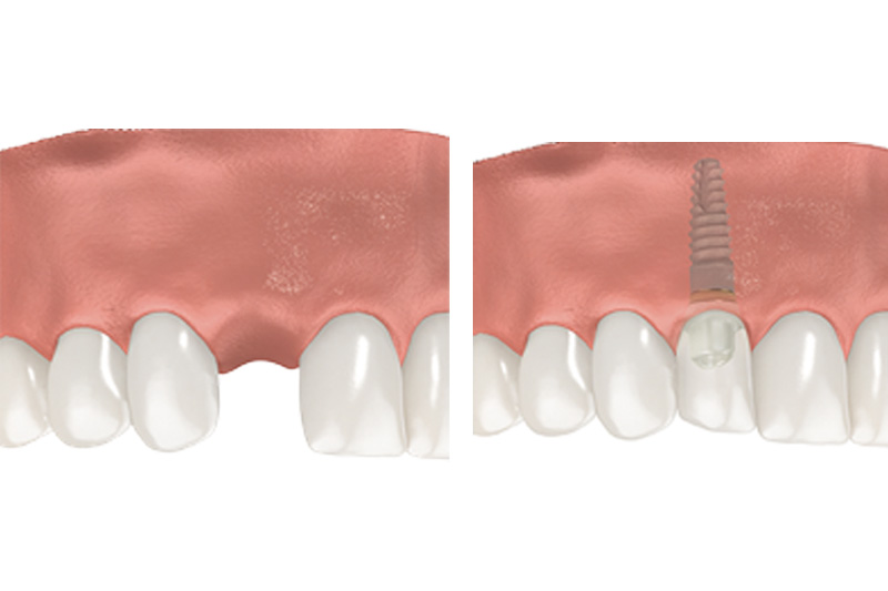Dental Implants - Millenia Dental, Chula Vista Dentist