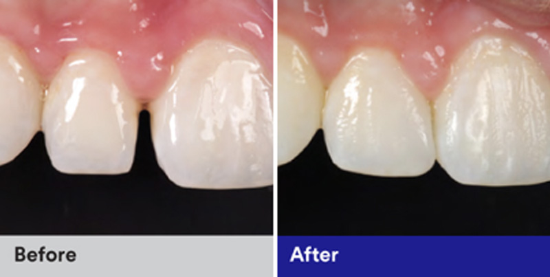 BioClear Diastema Closure and Black Triangle Closure  - Millenia Dental, Chula Vista Dentist