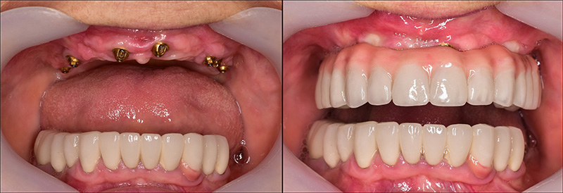 Implant Overdentures and Fixed All-On-X Treatment  - Millenia Dental, Chula Vista Dentist