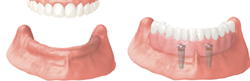 Implant Overdentures and Fixed All-On-X Treatment  - Millenia Dental, Chula Vista Dentist