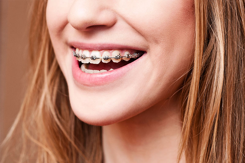 Orthodontics - Millenia Dental, Chula Vista Dentist