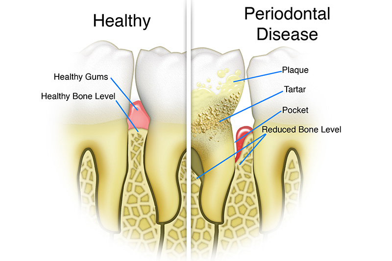 Scaling & Root Planings (Deep Cleanings)  - Millenia Dental, Chula Vista Dentist