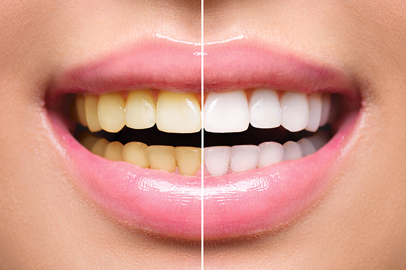 Teeth Whitening - Millenia Dental, Chula Vista Dentist