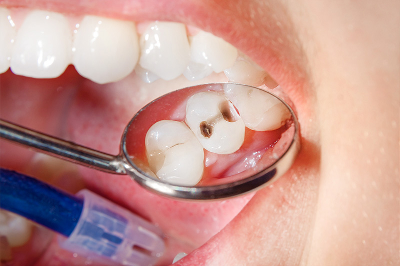 Tooth Colored Composite Fillings  - Millenia Dental, Chula Vista Dentist