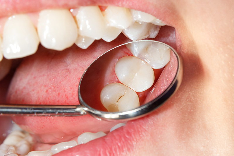 Tooth Colored Composite Fillings  - Millenia Dental, Chula Vista Dentist