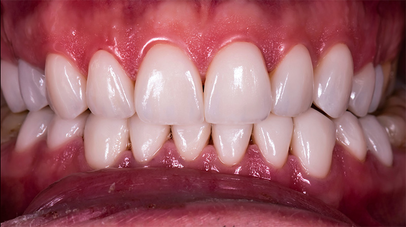 Veneers  - Millenia Dental, Chula Vista Dentist