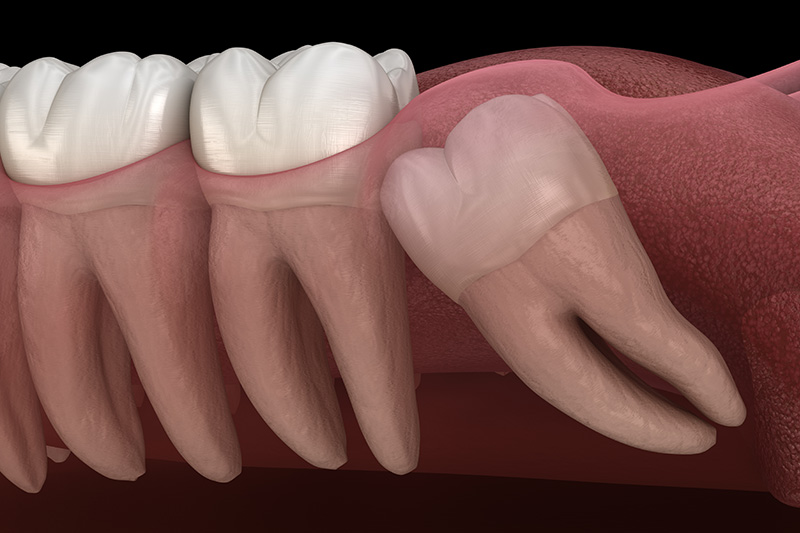 Wisdom Teeth Extractions (with Sedation)  - Millenia Dental, Chula Vista Dentist